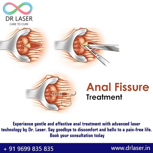 Say Goodbye to Anal Fissures with DR LASER CARE TO CURE! 