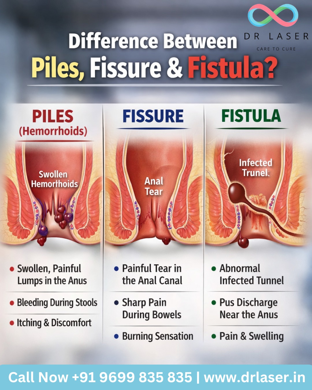 Confused between Piles, Fissure & Fistula? 