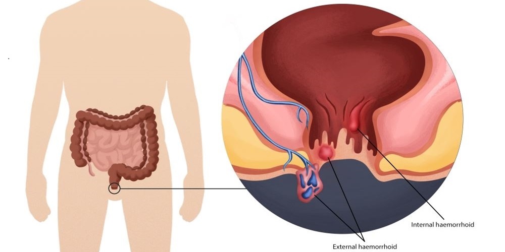 Anal Rectal Bleeding