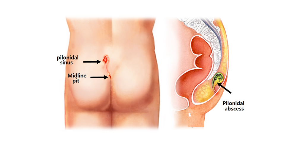 Pilonidal Sinus