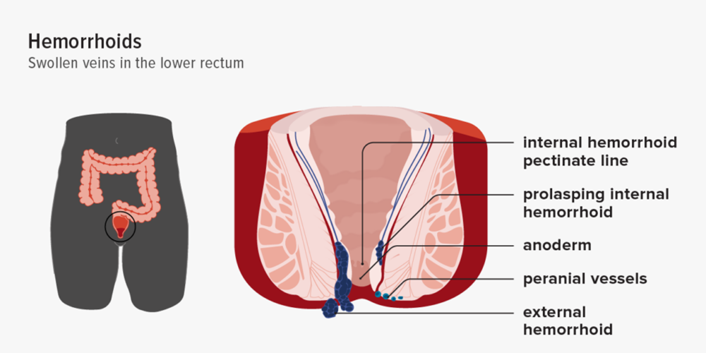 Piles (Hemorrhoids)